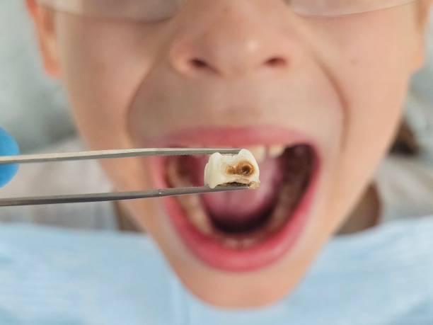 Best Emergency Treatment for Toothache in Eunice, LA
